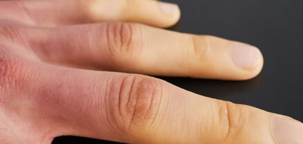 Բժիշկը նշել է ձեռքերից երևացող՝ վտանգավոր հիվանդությունների նշանները
