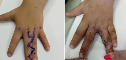 Վանաձորում բարդ վիրահատության արդյունքում վերականգնվել է 5-ամյա փոքրիկի մատների շարժունակությունը