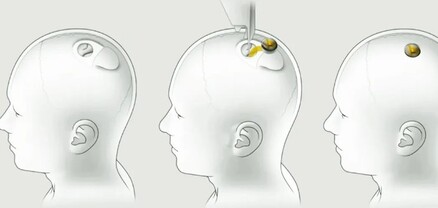 Առաջին անգամ մարդու գլխի մեջ տեղադրվել է Neuralink նեյրոչիպը