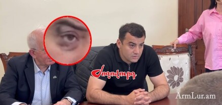 Արթուր Չախոյանի աչքը թաղապետի հարվածներից հետո կապտուկների մեջ է. armlur.am
