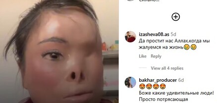 Այրված, բայց անկոտրում. աղջիկը ոգեշնչել է համացանցի օգտատերերին