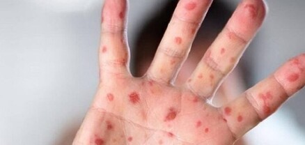 Կապիկի ծաղիկի բռնկումը այլևս չի համարվում միջազգային նշանակության առողջապահական արտակարգ իրավիճակ