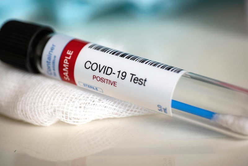 Երեկ հաստատվել է կորոնավիրուսային հիվանդության 493 նոր դեպք, կատարվել է 3954 թեստավորում