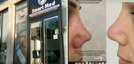 Քթիս ծայրը լրիվ տափակած էր, սարսափում էի ինձ նայելուց․ «ՍՄԱՐԹ ՄԵԴ»-ից տուժած քաղաքացի