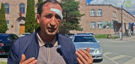ՔՊ ոհմակը հարձակվեց ինձ վրա, դեմքիս ծանր վնասվածք եմ ստացել. քաղաքացի